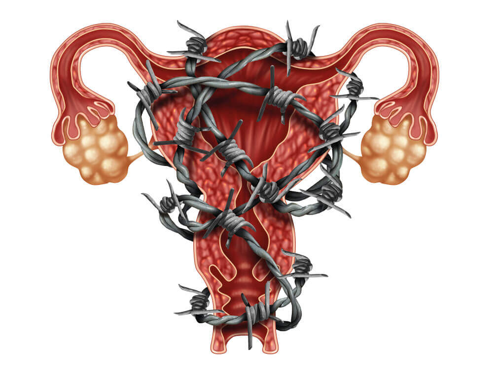 kvindesygdomme: endometriose er en af de sygdomme, der kun rammer kvinder