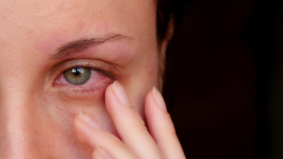 Et tegn på øjenbetændelse er bl.a. rødt øje. Lær de andre symptomer at kende