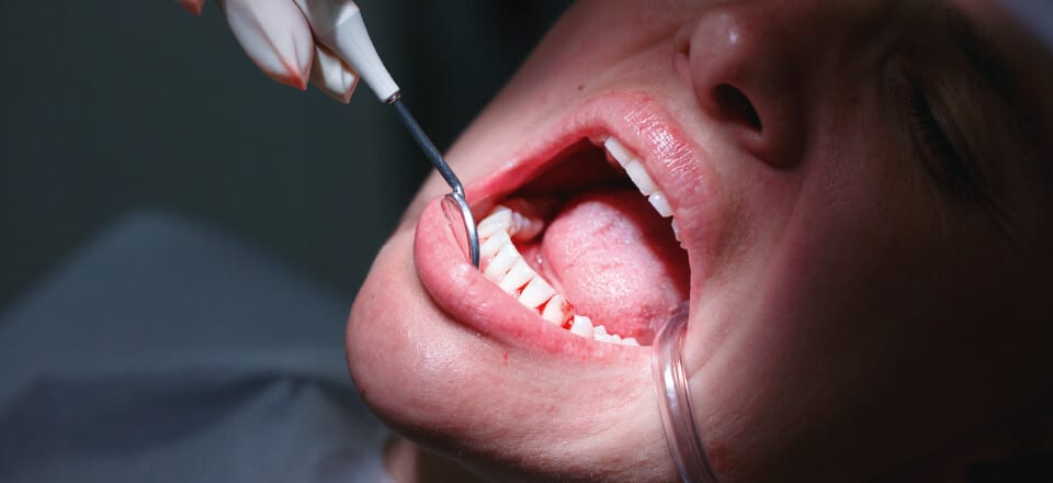 Parodontitis: En overset folkesygdom