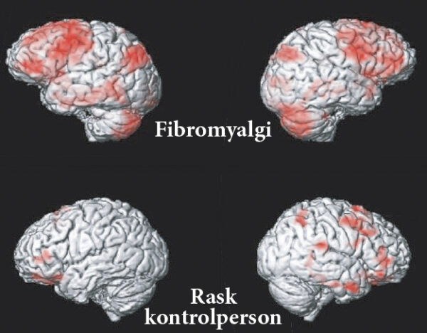 I forskningssammenhæng viser hjernescanninger, at mennesker med fibromyalgi reagerer kraftigere ved smertepåvirkninger end raske mennesker.